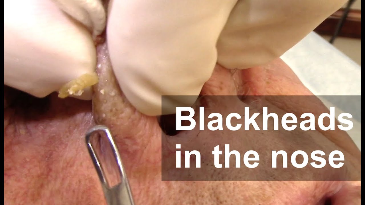 Dr. Derm extracts blackheads from a patient\'s nose.